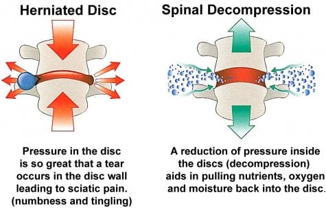 https://azchironeuro.com/wp-content/uploads/2017/05/spinal_decompression-description-picture-3-1-17.jpg