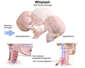 https://www.physio-pedia.com/images/thumb/7/78/Whiplash.png/300px-Whiplash.png?utm_source=chatgpt.com